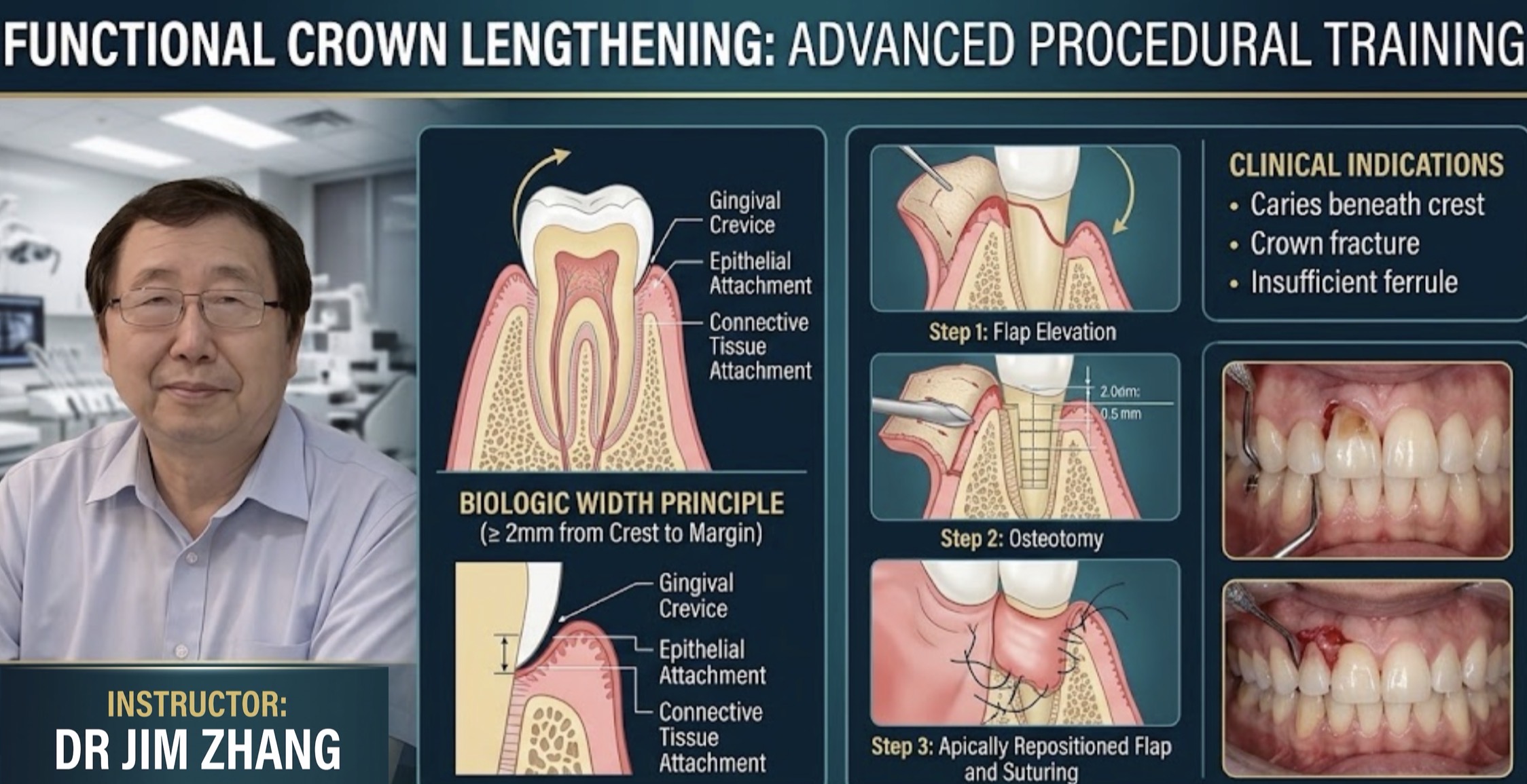 Dr. Jim Zhang teaching functional crown lengthening, including clinical indications, periodontal anatomy, flap elevation, osteotomy, and flap repositioning
